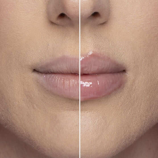 LIP INJECTION 1.5GR